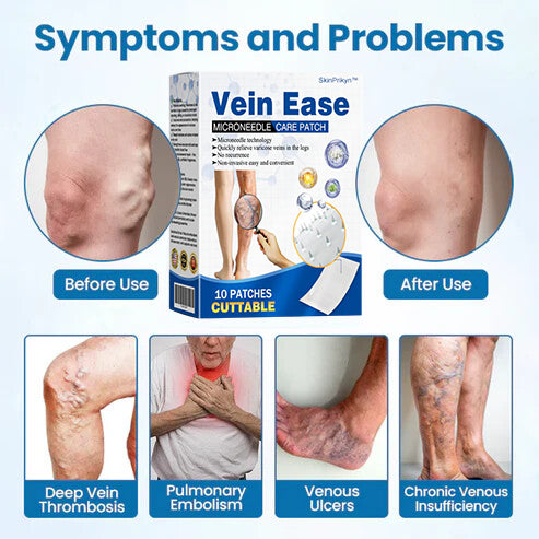 🔥Time-Limited Offer -SkinPrikyn™ Vein Ease Microneedle Care Patch - Cuttable (For Spider Veins, Varicose Veins, Swelling & Leg Fatigue)