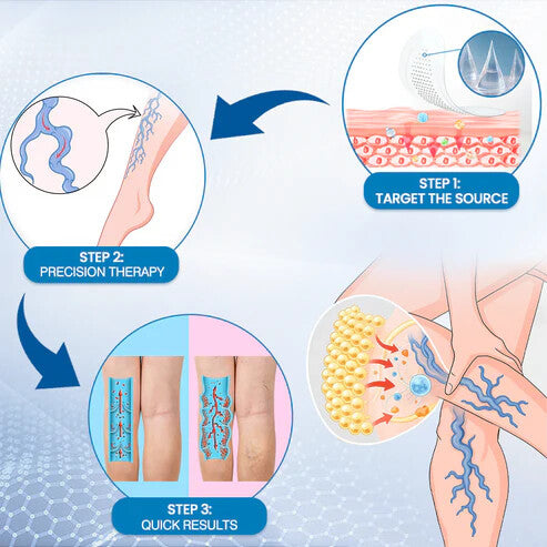 🔥Time-Limited Offer -SkinPrikyn™ Vein Ease Microneedle Care Patch - Cuttable (For Spider Veins, Varicose Veins, Swelling & Leg Fatigue)