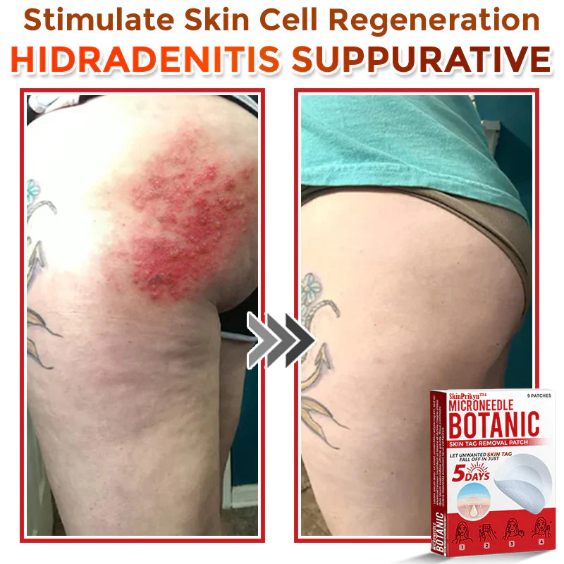 🌈🌈SkinPrikyn™ MicroNeedle Botanic Skin Tag Removal Patch 🇺🇸 Made in the USA