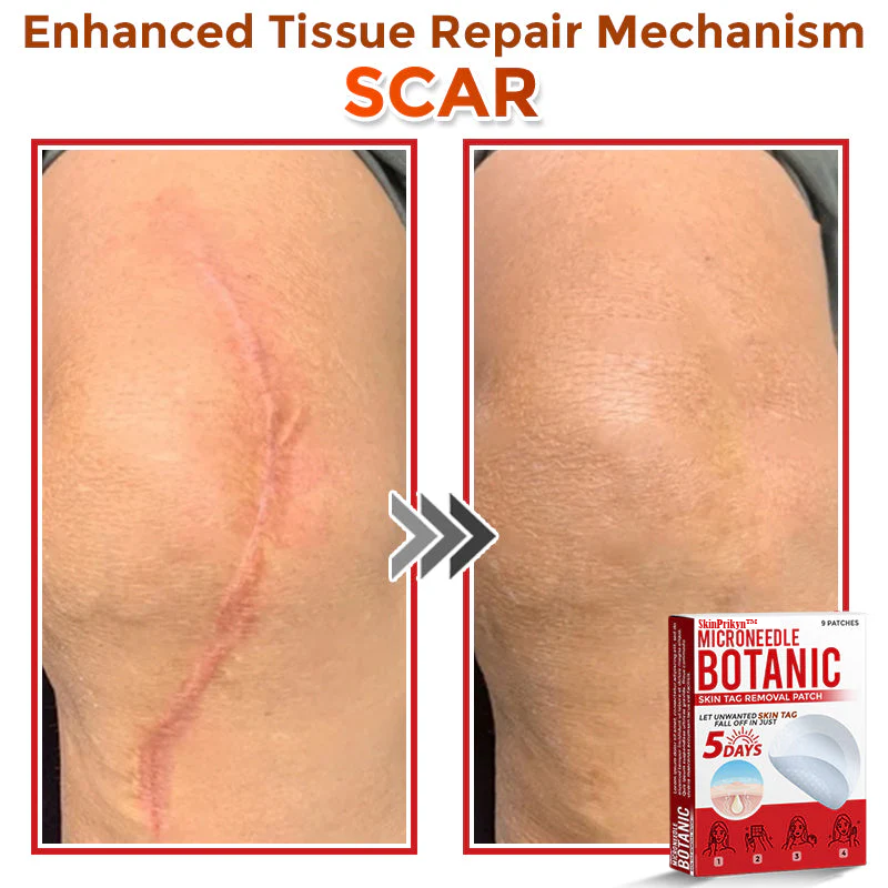 🌈🌈SkinPrikyn™ MicroNeedle Botanic Skin Tag Removal Patch 🇺🇸 Made in the USA