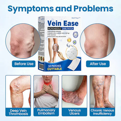 🔥Time-Limited Offer -SkinPrikyn™ Vein Ease Microneedle Care Patch - Cuttable (For Spider Veins, Varicose Veins, Swelling & Leg Fatigue)