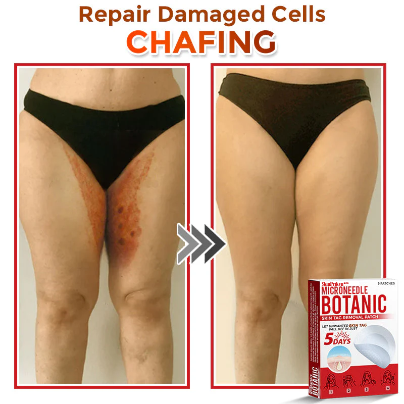 🌈🌈SkinPrikyn™ MicroNeedle Botanic Skin Tag Removal Patch 🇺🇸 Made in the USA