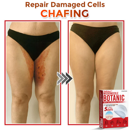 🌈🌈SkinPrikyn™ MicroNeedle Botanic Skin Tag Removal Patch 🇺🇸 Made in the USA