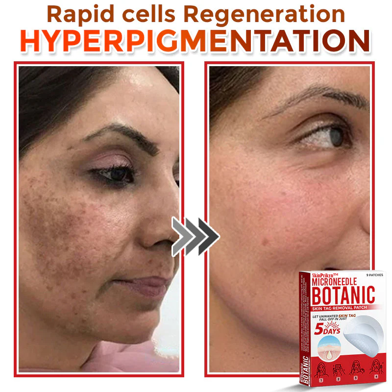 🌈🌈SkinPrikyn™ MicroNeedle Botanic Skin Tag Removal Patch 🇺🇸 Made in the USA
