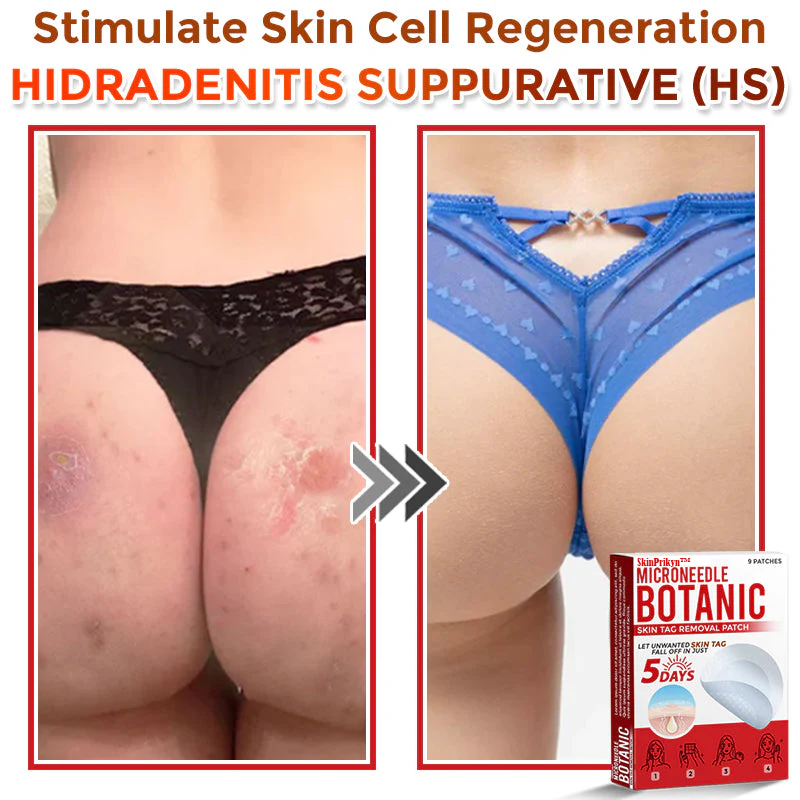 🌈🌈SkinPrikyn™ MicroNeedle Botanic Skin Tag Removal Patch 🇺🇸 Made in the USA