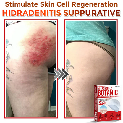 🌈🌈SkinPrikyn™ MicroNeedle Botanic Skin Tag Removal Patch 🇺🇸 Made in the USA