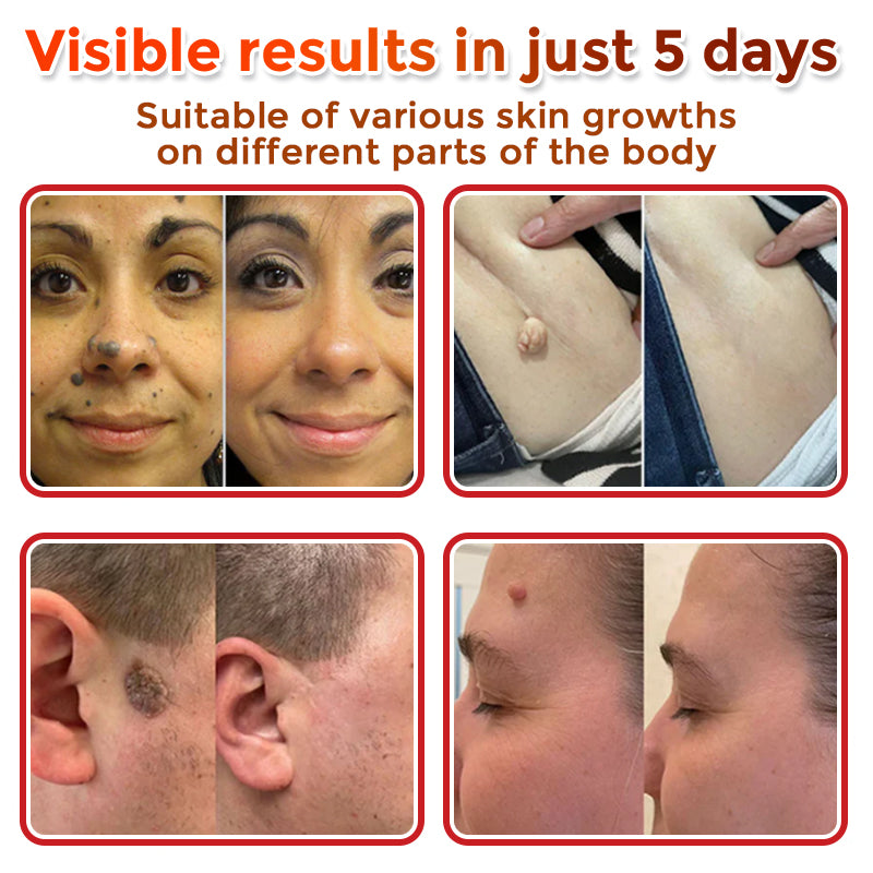 🌈🌈SkinPrikyn™ MicroNeedle Botanic Skin Tag Removal Patch 🇺🇸 Made in the USA